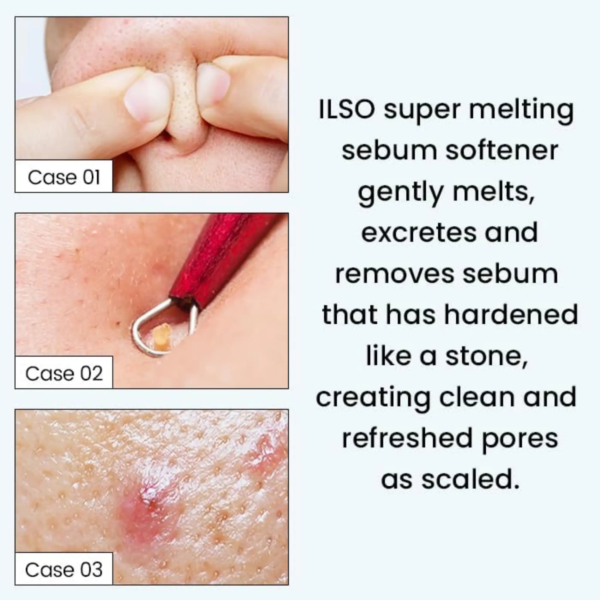 [ILSO] Super Melting Sebum Softener Special Set - SFOILER