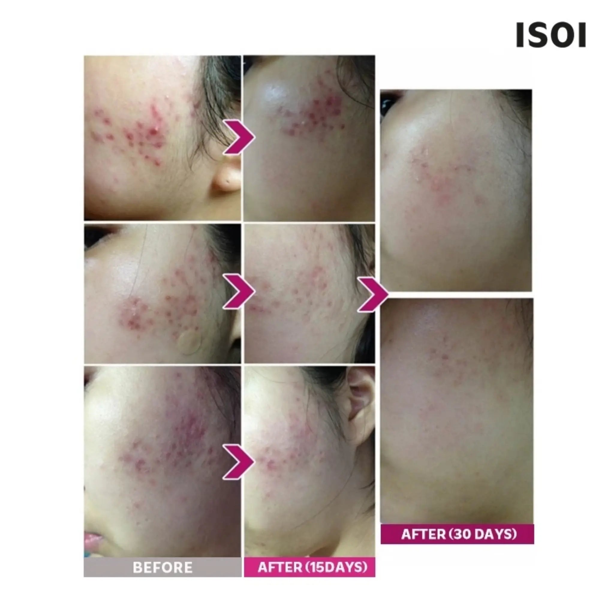 [ISOI] Blemish Care Up Serum Holiday Edition - 20ml - SFOILER